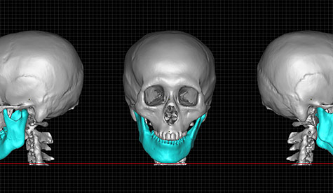 顎変形症への3Dプリンターの活用