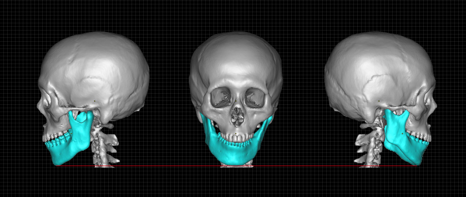 顎変形症への3Dプリンターの活用